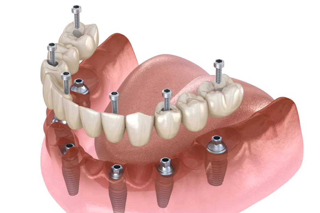 implant dentaire complet dentier Implants dentaires Mediweb - Template 5