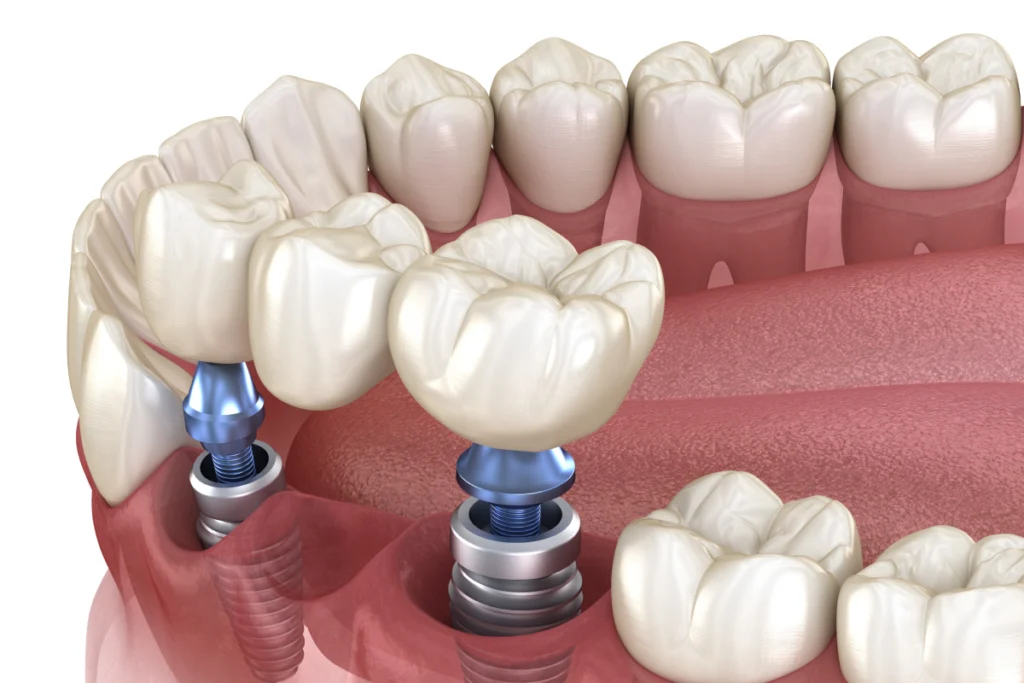 implant dentaire couronne bridge Implants dentaires Mediweb - Template 5