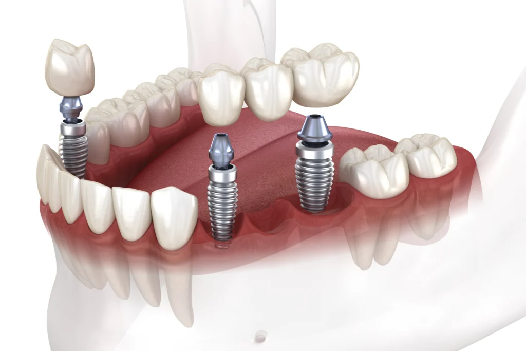 Implants dentaires